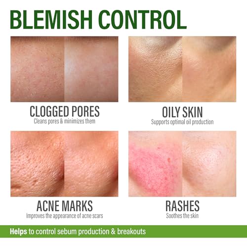 Acne-Supplements-for-Clear-Skin-with-Biotin-Zinc-Vitamin-A-Niacin-Acne-Pills-for-Acne-Scar-Treatment-Cystic-Acne-Treatment-with-Probiotics-for-Gut-Health-Glowing-Skin-Made-in-USA-60-Caps