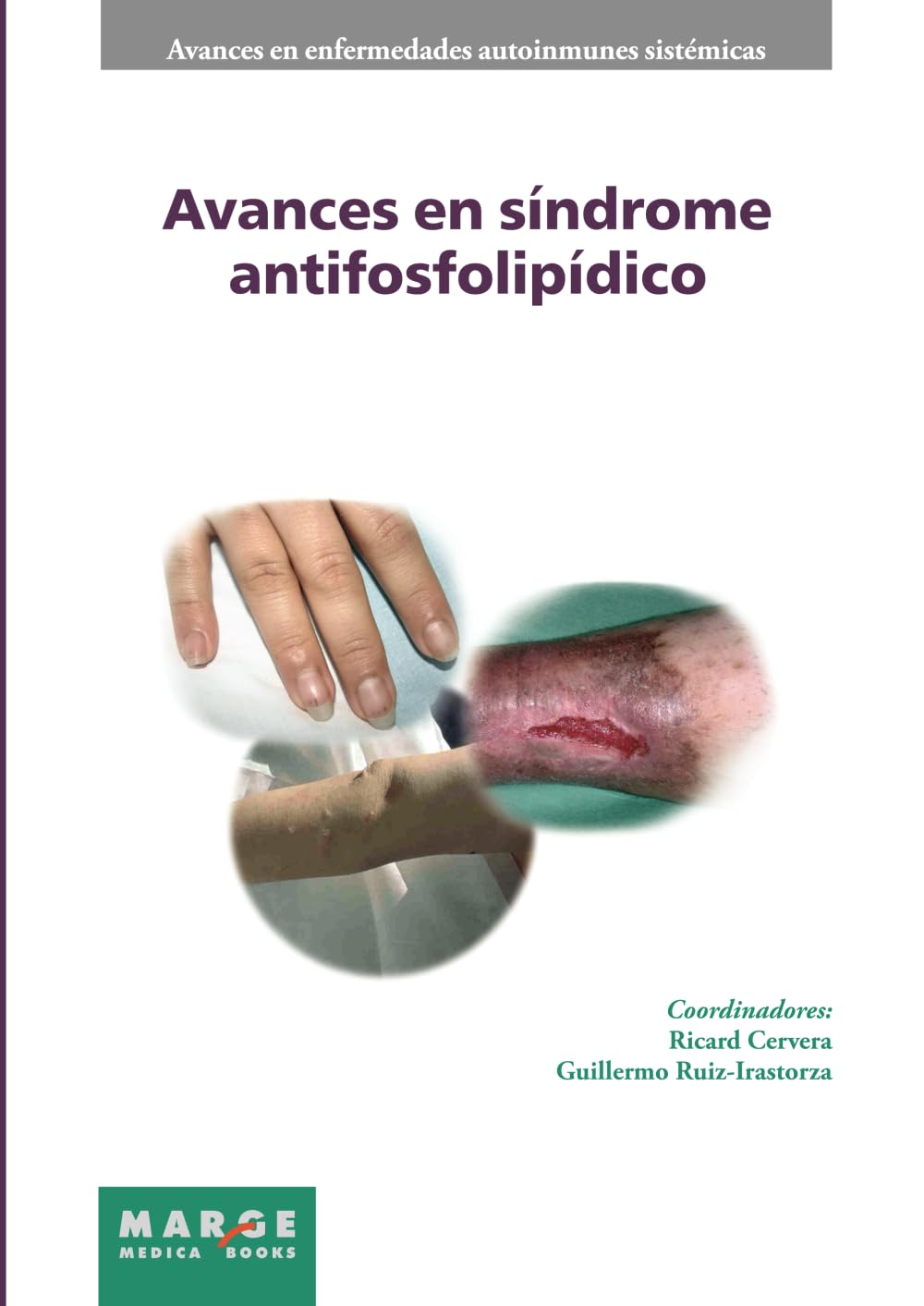 Avances en síndrome antifosfolipídico (Avances en enfermedades autoinmunes sistémicas)