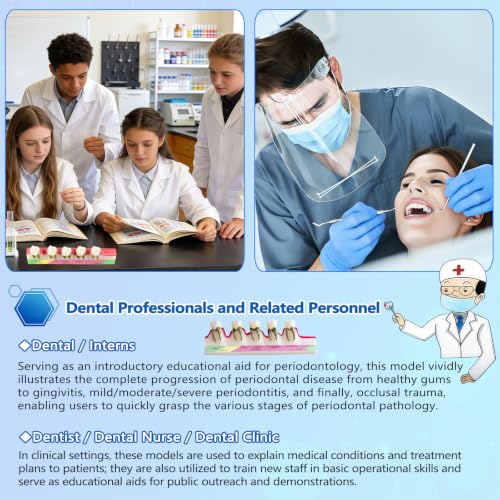 Image of Periodontal Disease Classification Model, 5-Stage Dental Anatomy Model for Dental Education,Dental Training,Demonstrations,Oral Care Education