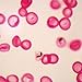 Plasmodium falciparum Slide, Smear