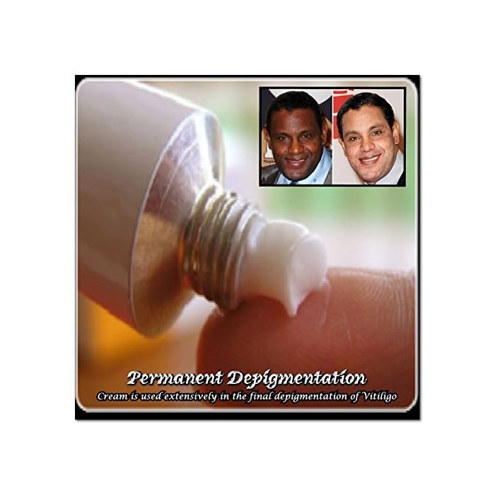 Buy 40 cream White Patches Permanent Scar Spot Obtain Depigmentation