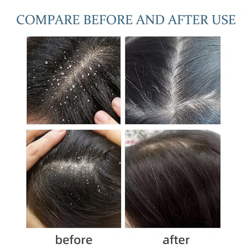 Image of Natural Anti Lice & Nits Remover Shampoo | With Rosemary, Tea Tree & Neem Oil Extracts | Lice Cleansing & Hair Protection Shampoo | Removes Itching from the Source | Chemical-Free | For All Hair Types(Free Lice Comb)(Pack of 1 = 200 ml)