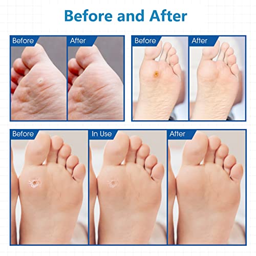 Mymulike Corn Removers For Feet, 48 Pack, Corn Removers Pads, Corn Removers For Toes Pads #TOP1