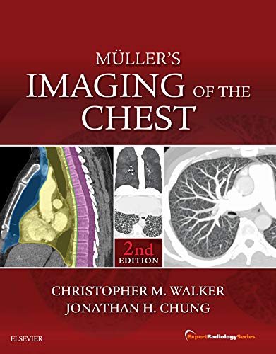 Muller’s Imaging of the Chest E-Book: Expert Radiology Series