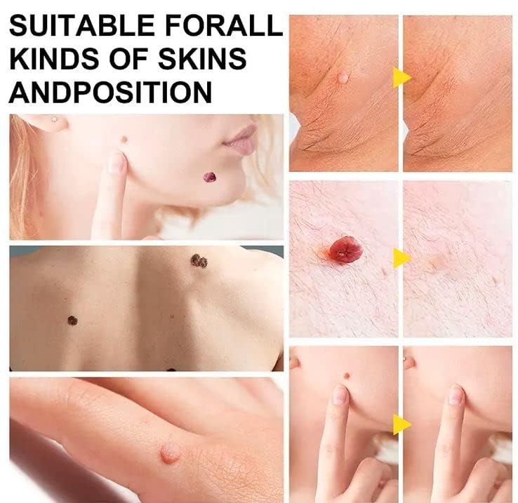 Image of Skin Tag Remover Set, Skin Tag Remover Kit 2 in 1, Skin Tag Removal Kit with Rubber Bands Rings for Removing Small to Medium