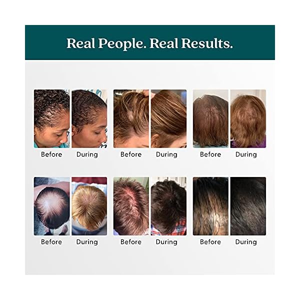 Shapiro MD Hair Growth Experts Vegan Hair Loss Shampoo for Thinning Hair | Experience Healthier, Fuller and Thicker Looking Hair (1 Month Supply)