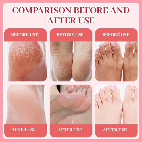 PQUELM Máscara nutritiva para pies de 9 piezas, máscara para pies con niacinamida, calcetines con crema para, crema hidratante, cuidado para pies secos y agrietados (melocotón + cereza + fresa) - imagen 4