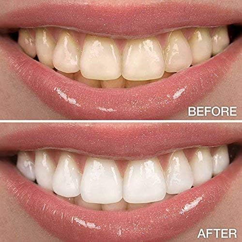 Novashine Professional Teeth Whitening Kit: Advanced Blue LED Light, Concentrated Peroxide Gel, Smartphone Adapter, Travel Bag