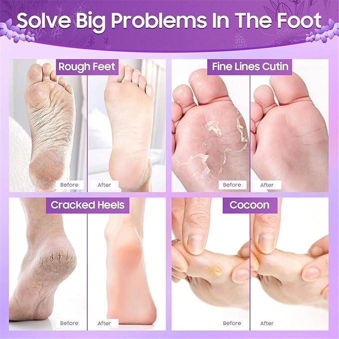 ERITIN Foot Peel Mask for Women & Men | Peeling & Exfoliating Foot Mask for Dry Cracked Feet, Removes Dead Skin & Calluses, Hydrates & Smooths Cracked Heels (Pack of 1) (LAVENDER) 1
