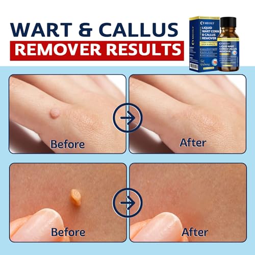 image for MEOLY Fast-Acting Wart Remover Freeze Off : Salicylic Acid Wart Remove