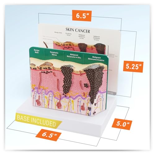 Image of GPI Anatomicals Skin Cancer Model, Skin Replica with Melanoma and Carcinoma | Human Body and Anatomy Replica for Physiology Education, Anatomical Model for Doctor's Office, Medical Learning Resources