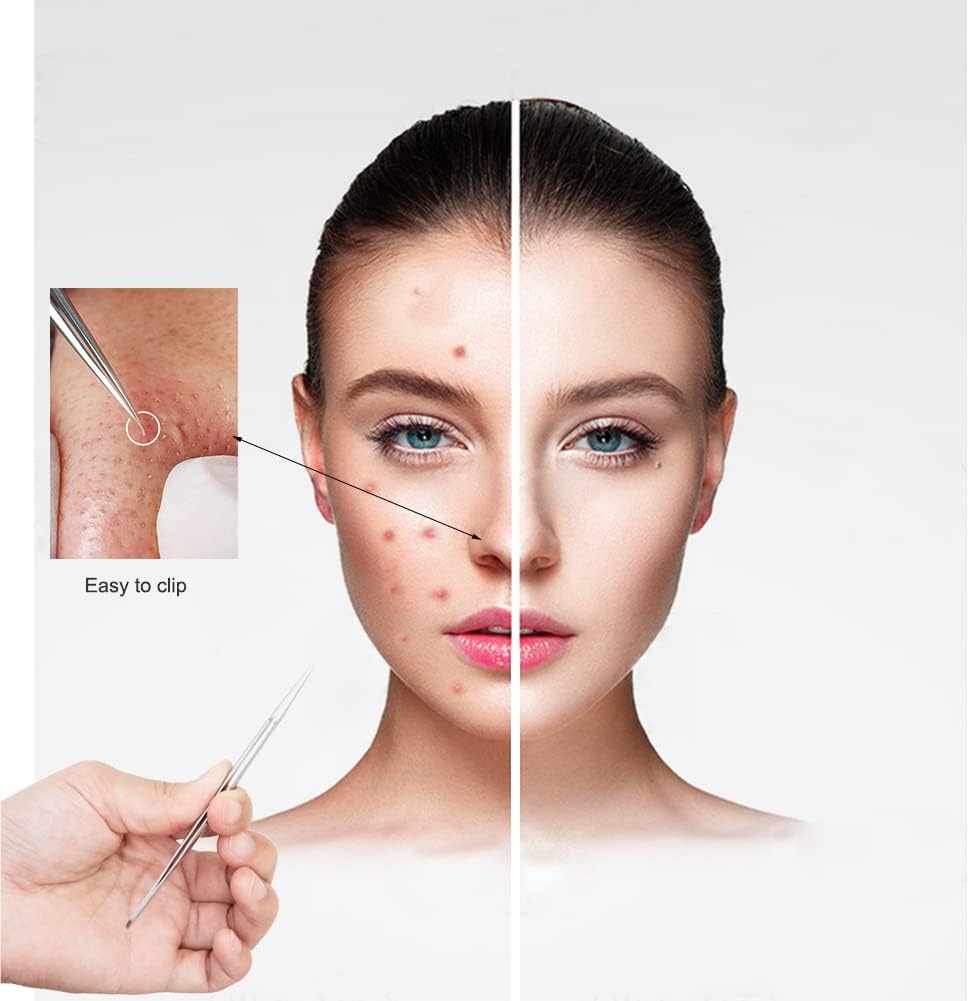 Stainless Steel Ingrown Hair Tweezer Fine Point Tweezer Professional ...