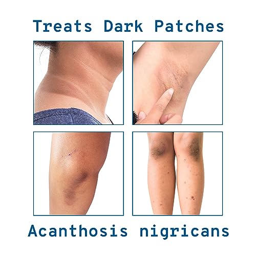 Be Bodywise Pigmentation Cream 100gm | 2.5% Lactic Acid, 2% Urea, Retinol & Kojic Acid | Reduces Tan, Pigmentation & Evens Skin Tone | Treats Dark Patches & Rough Skin on... - Image 6