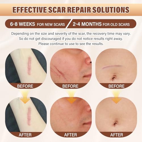 Psecici Silicone Scar Sheets,Silicone Scar Tape,Silicone Sheets For Scars,Scar Tape For Surgical Scars,Silicone Scar Removal Strips For C-Section,Tummy Tuck Scars Keloid Bump Removal thumb #1