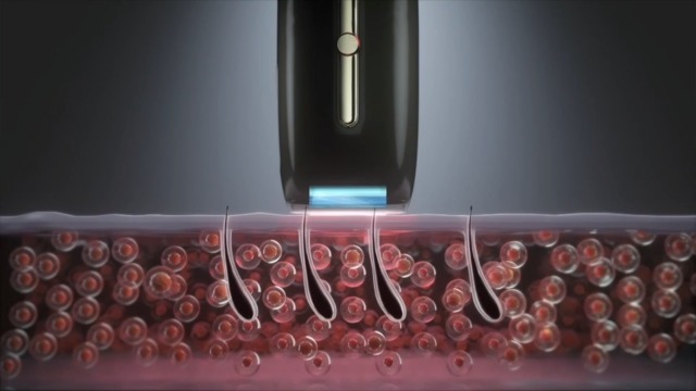 Ulike Rose IPL Hair Removal for Women & Men Nearly Painless Long