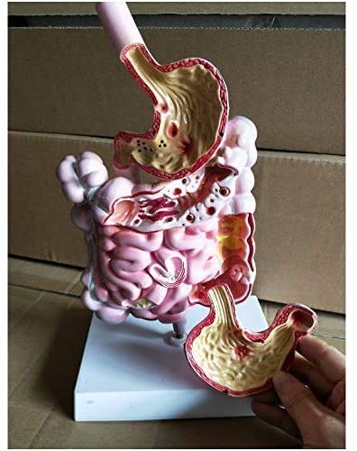 ERNZI Modelli di Materiali Educativi, Modello Educativo Modello di Malattia del Sistema Digerente - Modello di Organo Modello Umano
