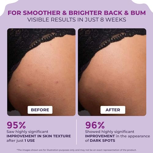 Sanfe Back & Bum Cream for Dark Spots and Body Acne | Glycolic Acid, Lactic Acid & Urea | 11% AHA & Maximum Exfoliation | Remove Dead Skin for Women | 100gm - Image 3