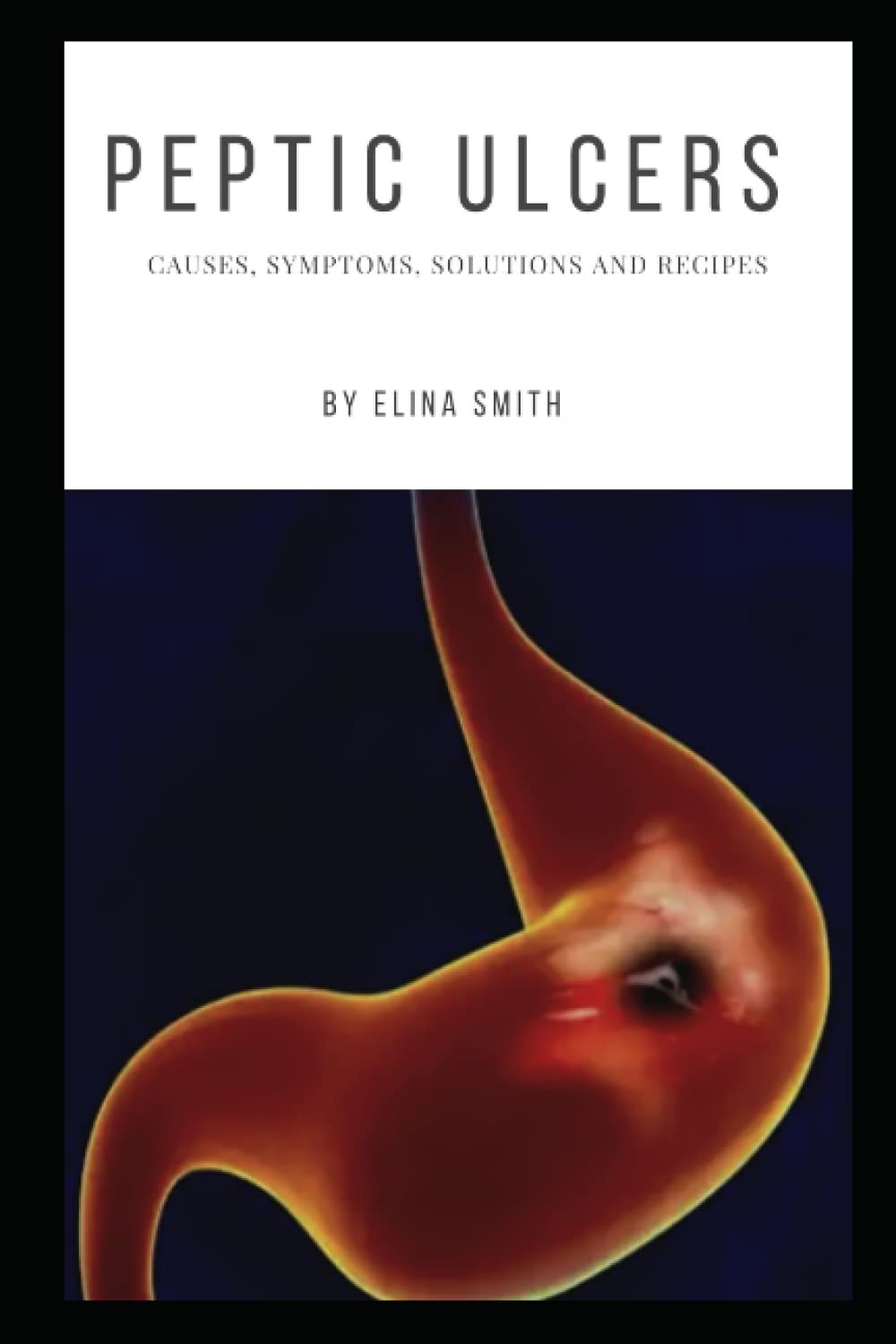 PEPTIC ULCERS: CAUSES, SYMPTOMS, SOLUTIONS AND RECIPES