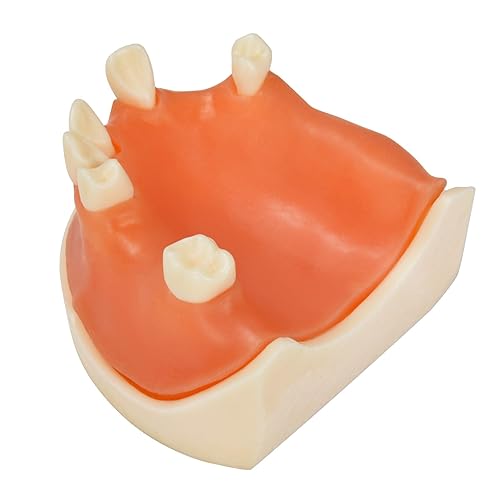 Miniatura 2 de Ultrassist Modelo de implante dental maxilar, modelo básico de entrenamiento de implantes con práctica de encías blandas, gran diente de