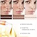 Freckle Remover, Dark Spot Removal, Melasma Remover, Dark Spot Corrector, Freckles Dark Spot, Removes Hyperpigmentation Reduces Melasma Lightens(15g)