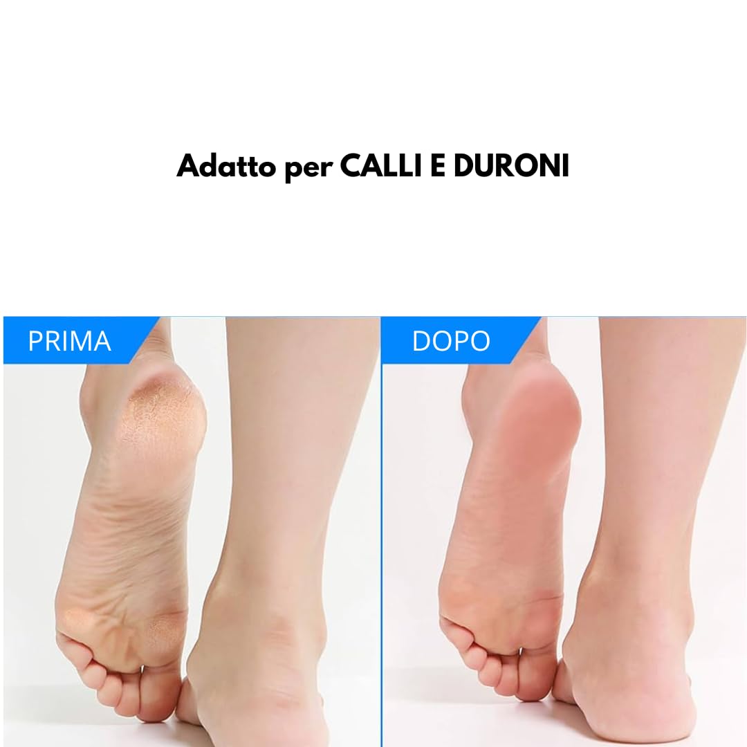 kit sgorbia per pedicure professionale, Manico e sgorbie per pedicure 2 pezzi per N° 2-4-6-8-10-12 In acciaio Inox temprato Eliminano la radice dei calli anche più estesi