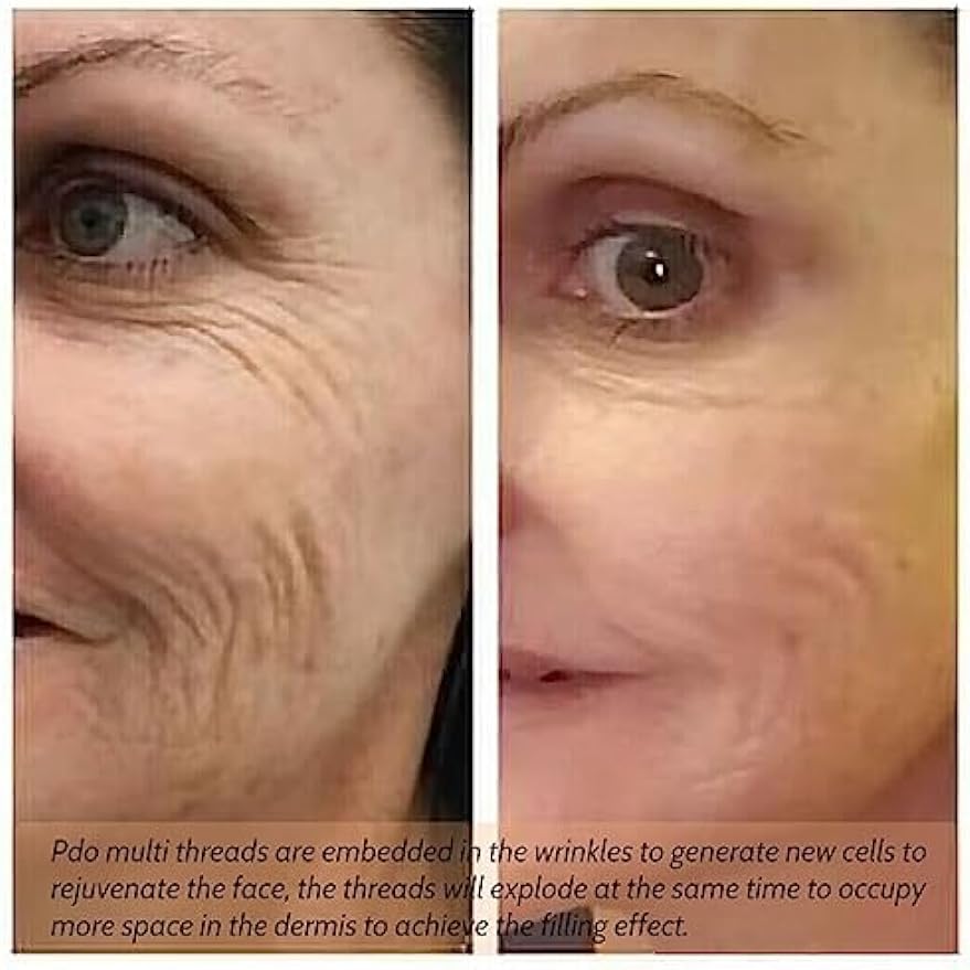 Miniatura 4 de Pdo Pcl Multi Hilos, 23G38MM, para estiramiento facial, eliminación de arrugas Nasolabial L-Tipo, 20 piezas... (PDO)