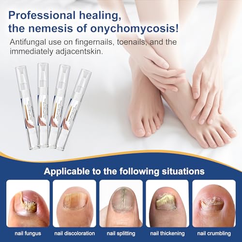Image of Toenail Fungi Treatment Extra Strength - Fungi Nail Pen, 25% Undecylenic Acid, Ingrown toenail treatment, Fungus nail treatment, yellow toenail, Damaged Nails foot fungus treatment extra strength