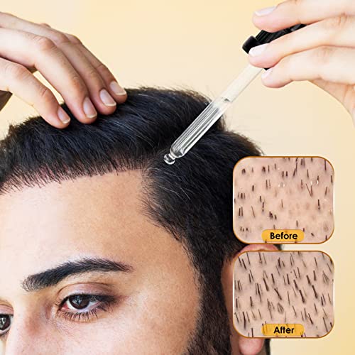 Minoxidil 5% Hair Growth Serum Oil Biotin Hair Regrowth Treatment For Scalp Hair Loss Hair Thinning, Hair Growth Serum For Men Women 1 Fl.oz #TOP4
