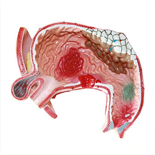 Modelo Anatômico de Estômago Humano Mudanças Patológicas Anatomia para Sala de Aula Estudo Modelo Mé
