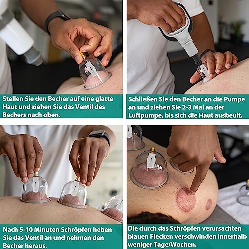 24 Stück Schröpfgläser mit Vakuumpumpe,Schröpfsets für Entspannen Muskeln – Ansicht 3