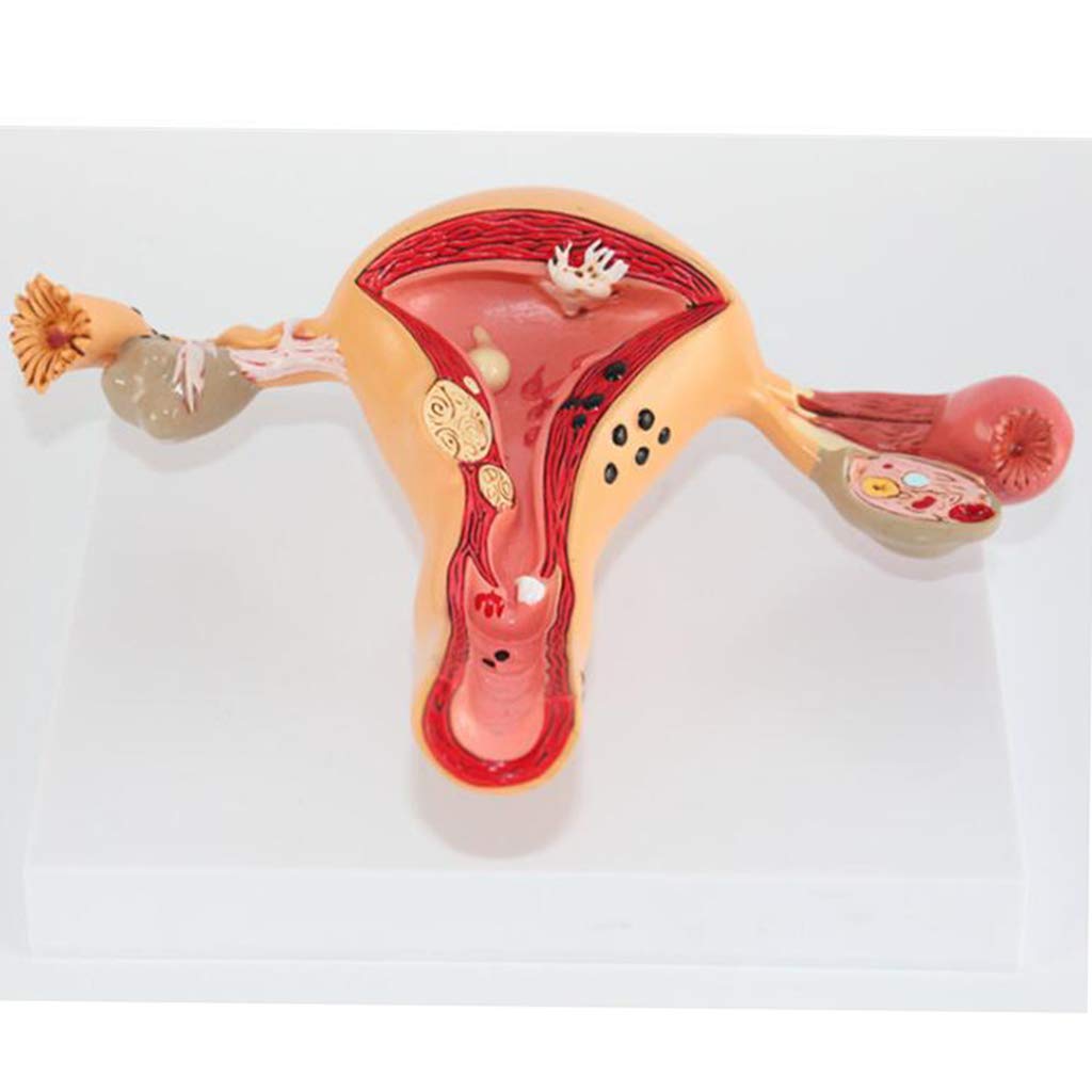 sjdoPulse Uterine Lesion Model - Female Internal And External Organs Anatomical Model - PVC Human Anatomy Science Models - for Gynecology Training Aid Medical Training Model