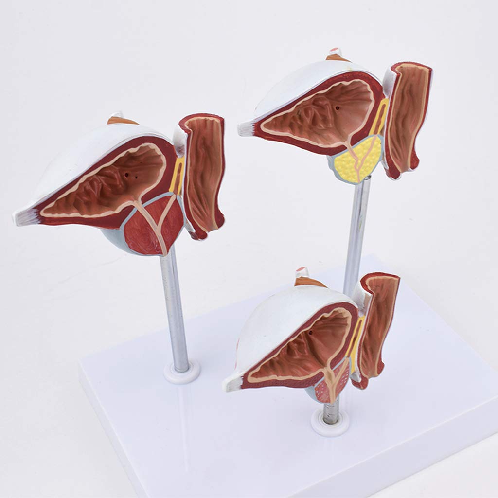 Model Prostaty Naturalnej Wielkości - Prezentacja Normalnych I Uszkodzonych Modeli Prostaty Porównaj Modele - Materiał Pcv Modele Naukowe Anatomii Człowieka - Do Wyświetlania W Badaniach Model Naucza