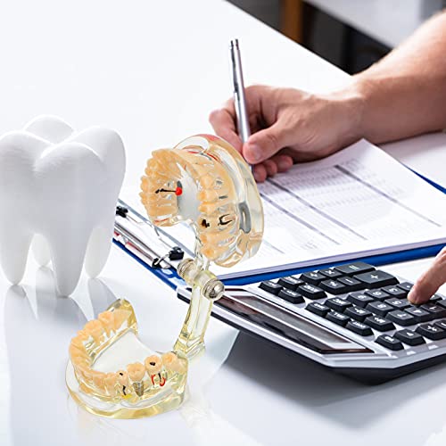 DOITOOL Tandheelkundig implantaat Tanden Model Transparante Volwassen Pathologieën Implantaat Demonstratie Tanden… - Image 6