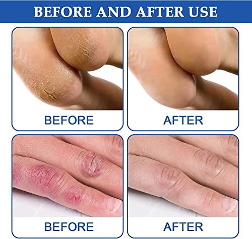 Chilblain Cream-Anti-Cracking Frostbite Moisturiser Deep Nourishing, Cracked Skin Repair Cream, Foot Repair Cream, Anti Crack Hand Foot Cream, For Dry Cracked Heels Callus Remover. (1 Pcs) #TOP2
