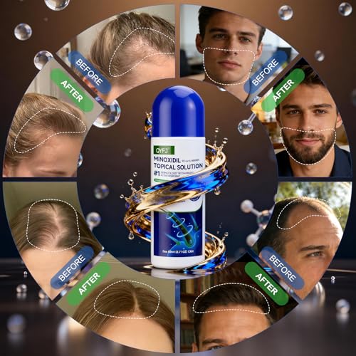Image of 3 Pack 5% Minoxidil for Men and Women,Minoxidil Beard and Hair Growth Serum(Biotin-Infused) with Sponge Applicator for Thinning Hair and Sparse Beards,4-Month Supply 3 x 2.7 FL OZ