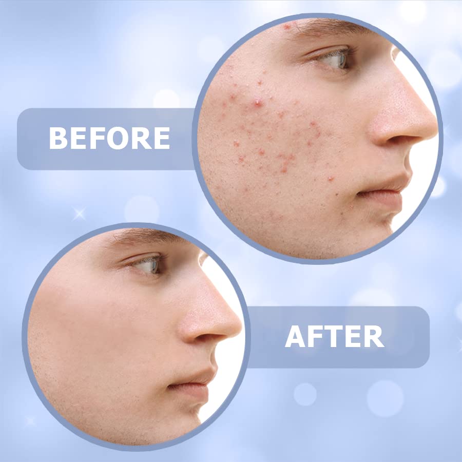 Miniatura 4 de Hojas de gel de silicona para cicatrices - Crema de cicatrices para cicatrices quirúrgicas - Paquete de 5 parches de silicona para cicatrices y gel