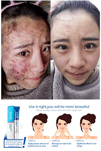 Acne Cleaning Cream Blackhead Skin Care Remove Repair Comedone Pimple Acne Quickly Face Acne Cream Remover Anti Acne