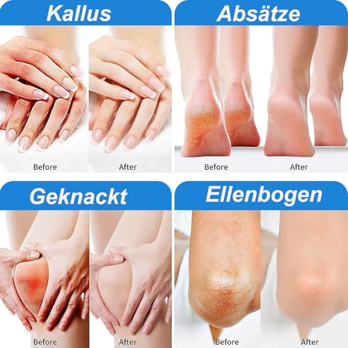 Urea Creme 40 Prozent, Fußcreme sehr Trockene Füsse, Hornhaut Entferner & Schrundensalbe mit Befeuchten, Fusspflege für Sehr Trockene Füße, Urea Lotion, für Hände und Füße – Bild 6