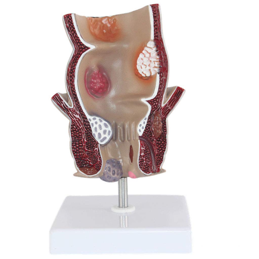 Sjdopulse Magnify 1.5 Times Rectal Pathology Model - Human Organ Anatomy Mode Acne Anorectal Rectal Disease Demonstration Model - For Medical Educational Training Aid