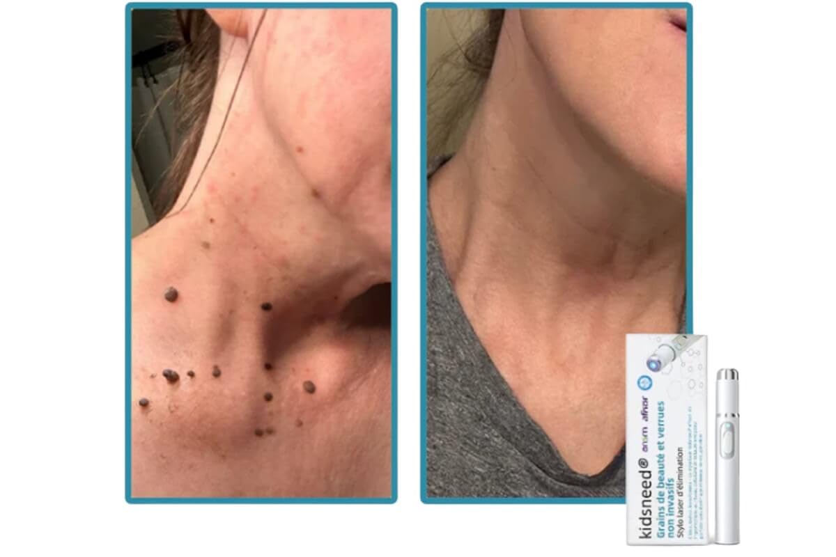 derma care Kidsneed 2.0 -Stylo Laser Non-Invasif L'élimination Efficace Des Verrues et Grains de Beauté