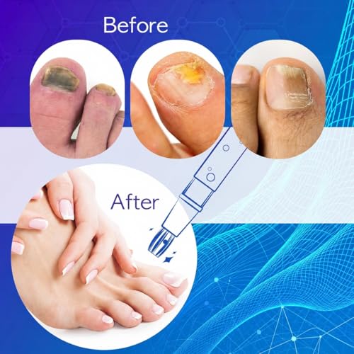 Nail Fungus Pen, Toenail Fungus Pen Treatment for Toenails & Fingernails, Daily Nail Appearance Care - 4 Count - Image 6