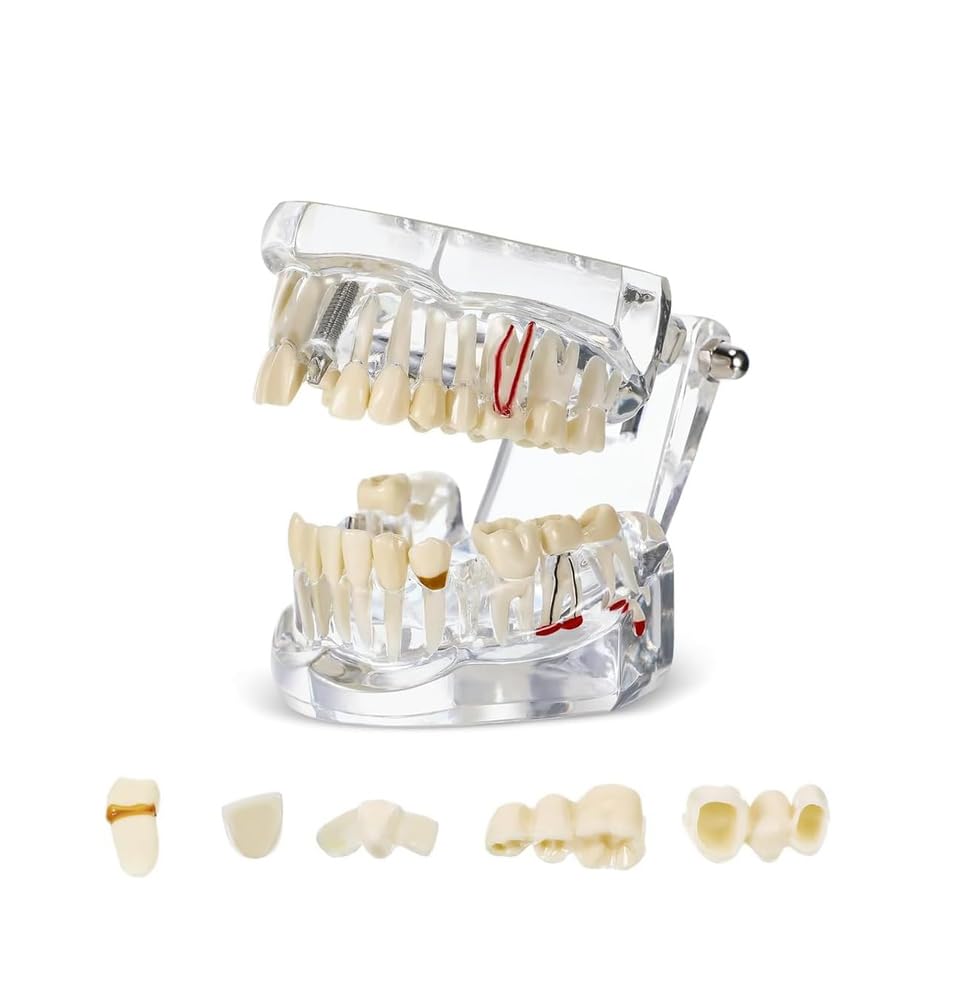 Modello di Denti Trasparente Modello di Malattie Dentali Typodont Dentale Modello di Denti per Impianti con Denti Rimovibili Dimostrazione Standard del Dente per Dentisti