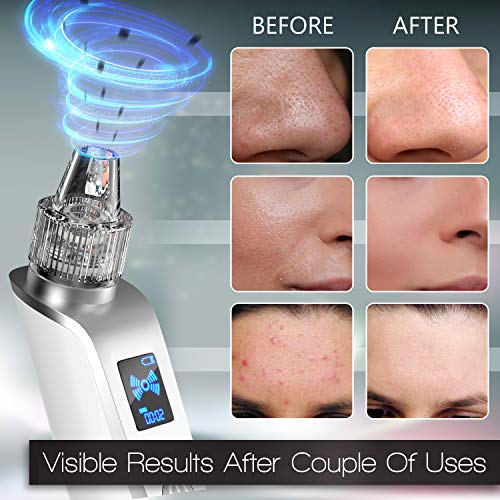 olrom blackhead remover