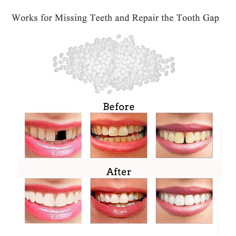 DIY Cosmetic Teeth Repair 10g – Temporary Moldable Dental Kit - Image 5 thumbnail