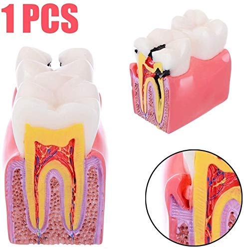 Insegnamento del Modello di Anatomia Dentale Educazione per Studenti di Odontoiatria E Ricerca sulle Carie 6 Volte Studio Comparativo del Modello 1 Strumento Assistente di Biologia Anatomica