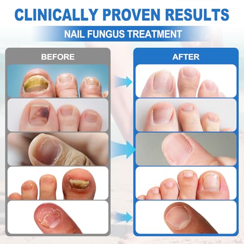 Toenail Fungus Treatment Extra Strength: Fungus Nail Treatment Fast Acting - Nail Fungal Treatment for Toenail and Fingernail - Nail Fungus Treatment for Men & Women - 30ML