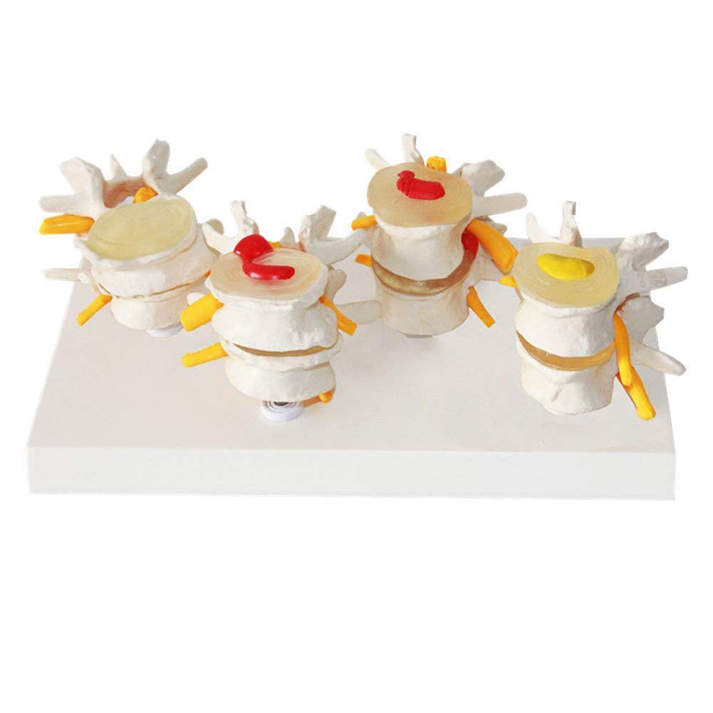 IVQAPP 4-Part Combined Model Normal lesions The Spine and Lumbar The Lumbar Spine lesions Show A disc Disease Medicine Theory pathological Models for School Education