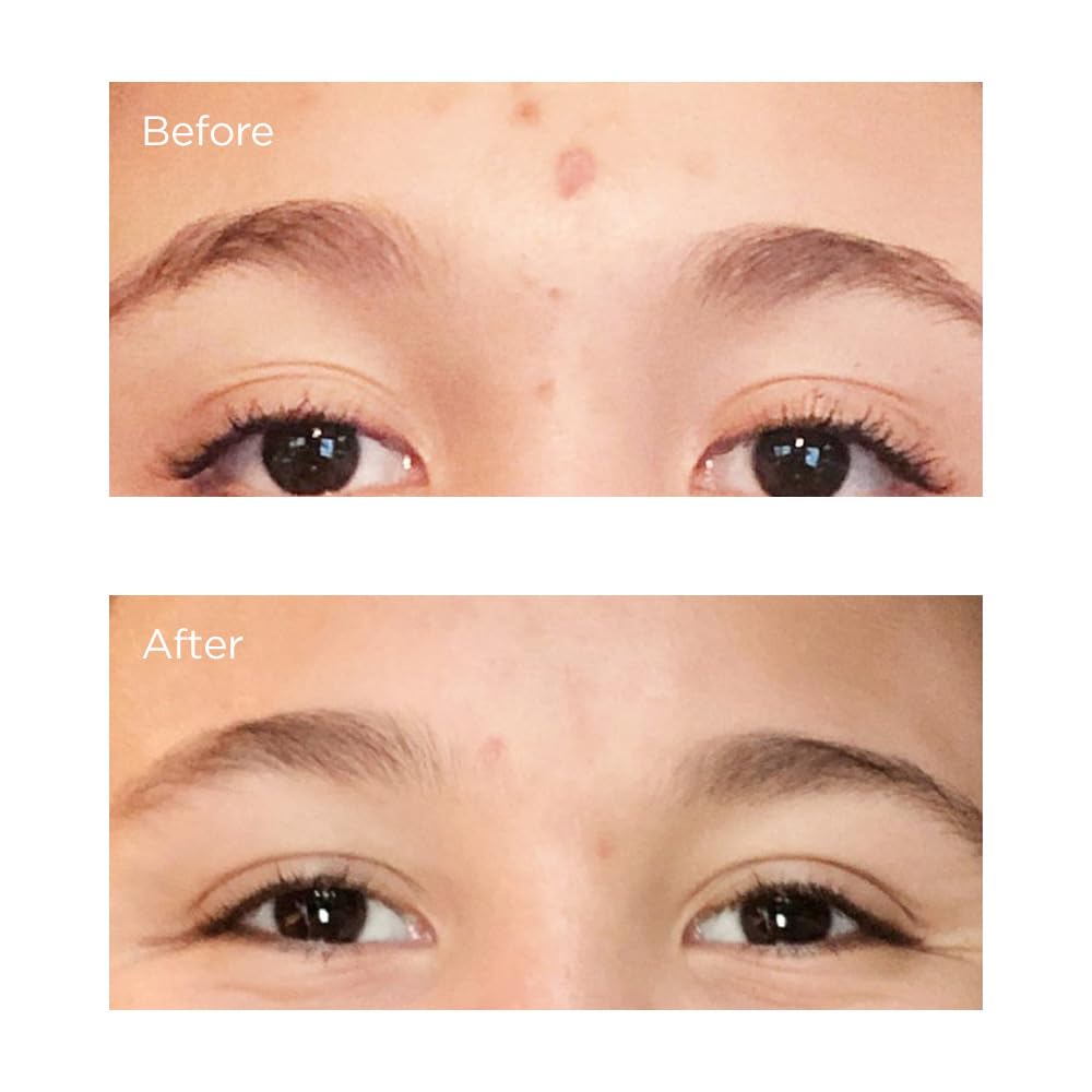 Acne Relief Prebiotic Acne Therapy