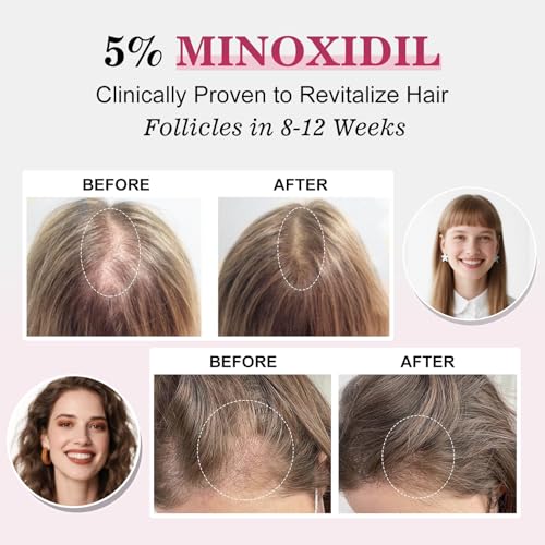 5% Minoxidil for Women Hair Regrowth Spray, hers hair regrowth treatment Infused with Biotin, Extra Strength Treatment to Combat Hair Loss and Thinning, 6 Bottles（100 Ml)3