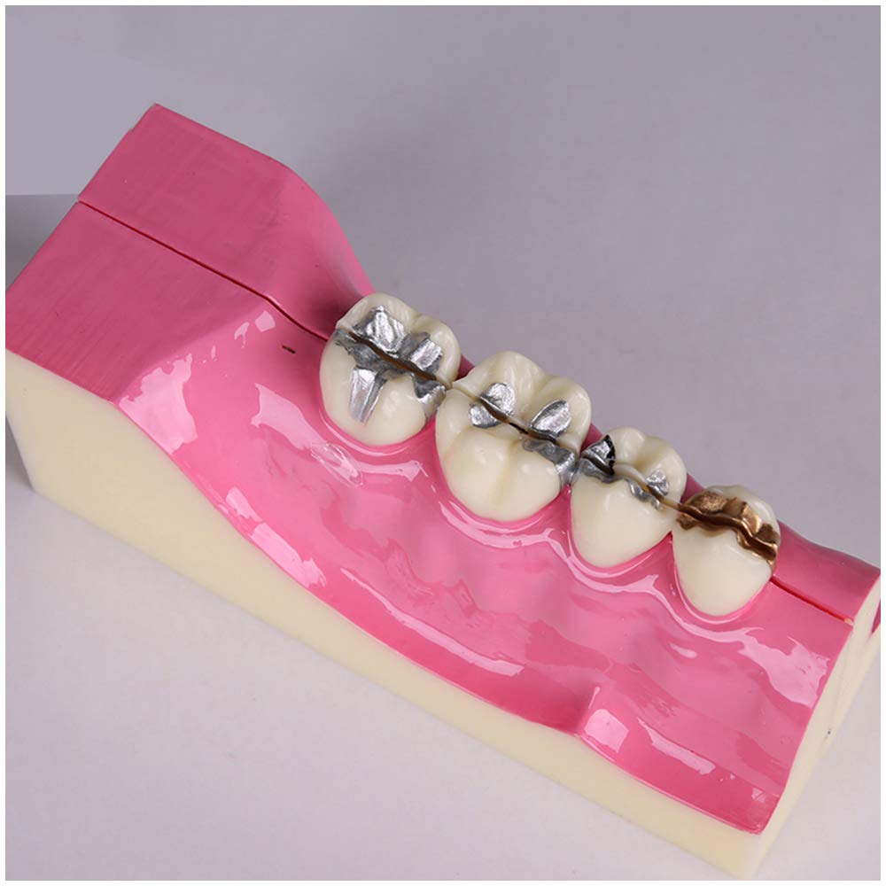 Sjdopulse A Teeth Model For Education - Right Lower Back Teeth Organizational Decomposition Model - Simulation Oral Tooth Teeth Demonstration Model - For Study Teaching (A)